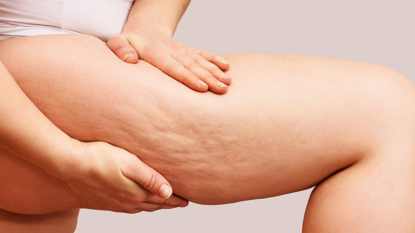 4 Easy Steps To Beat Cellulite By A Qualified Expert