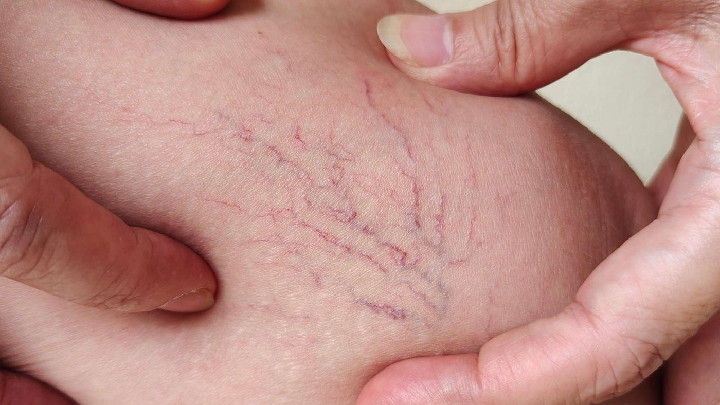 Understanding Thread Veins: Causes, Triggers & Treatment Options